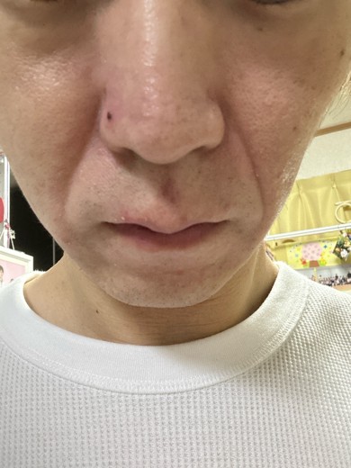 after photo: 糸リフト, 診断・検査