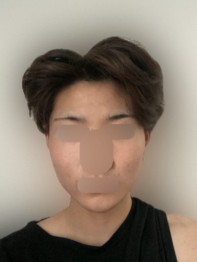 before photo: ダーマペン