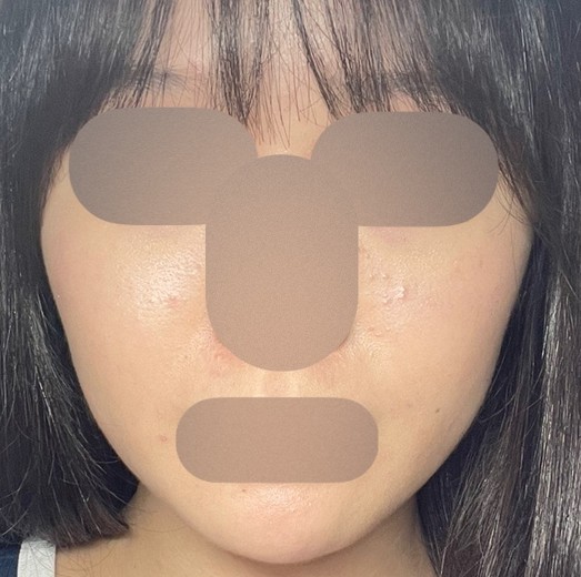 before photo: ハイドラフェイシャル, エレクトロポレーション