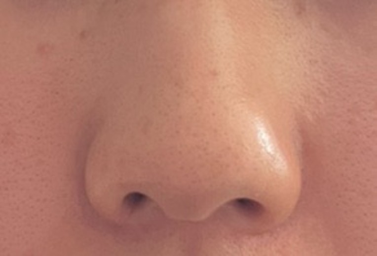 after photo: 小鼻ボトックス, 脂肪溶解注射(顔)
