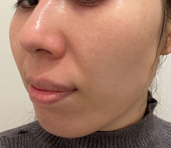 before photo: ジュベルック(Juvelook), サブシジョン(ニキビ跡治療)