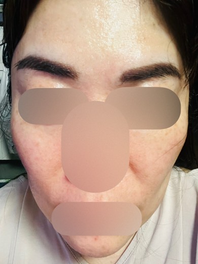after photo: ヴェルベットスキン