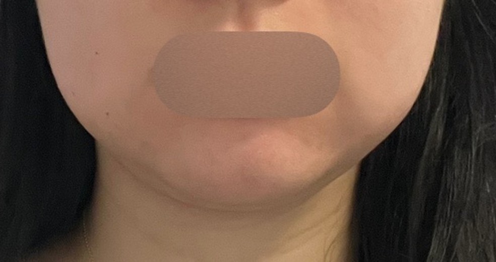 after photo: 윤곽주사