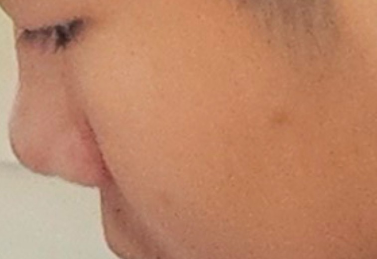 after photo: PDT레이저, 여드름압출