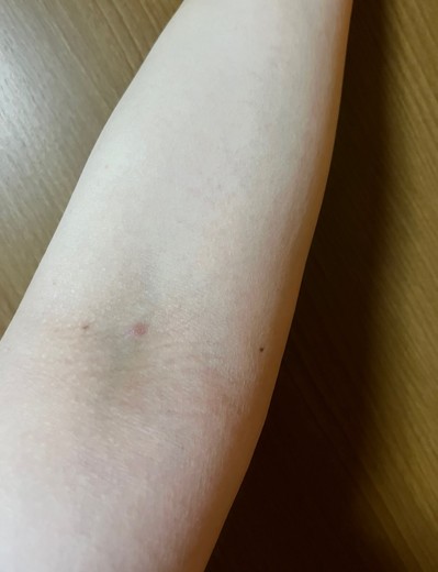 after photo: 白玉注射・点滴, 美容注射・点滴