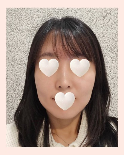 before photo: 티타늄리프팅