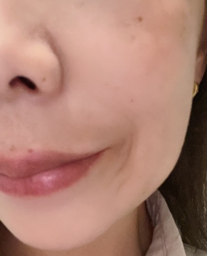 after photo: 前頬骨ヒアルロン酸