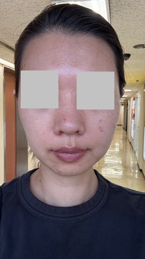 after photo: イオン導入