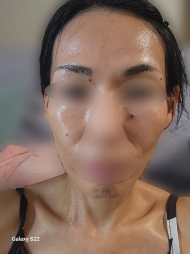 after photo: 水光注射