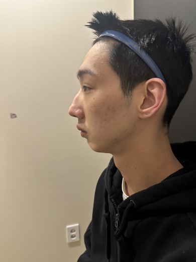 before photo: 콧대(자가조직), 콧대(보형물)