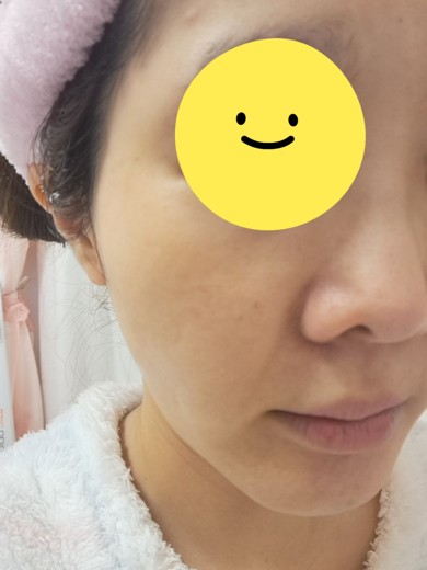 after photo: ピーリング, エレクトロポレーション, ルメッカ