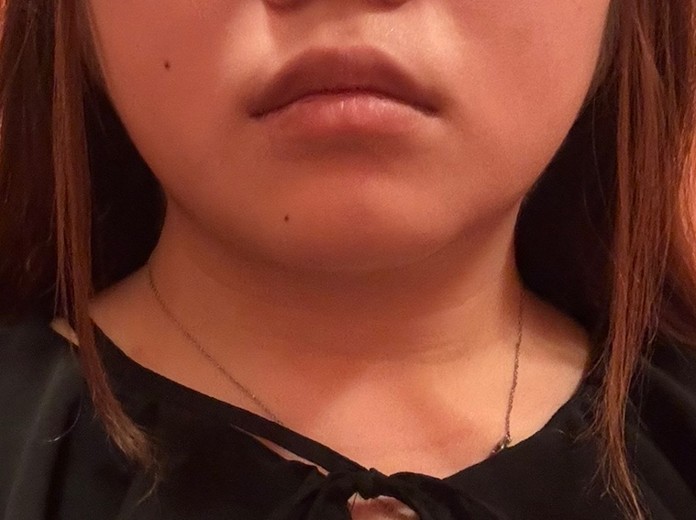 before photo: 脂肪溶解注射(顔)