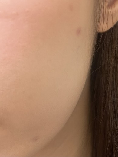 after photo: 피코토닝, 제네시스