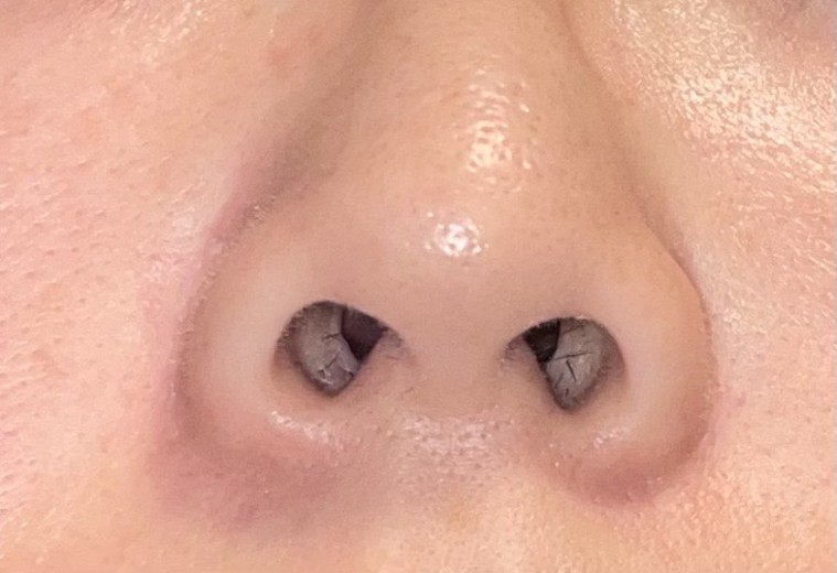 after photo: 脱毛(顔)