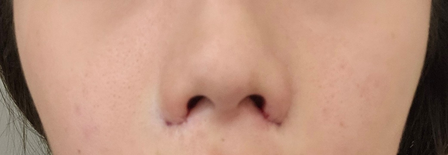 after photo: 콧볼축소