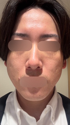 after photo: ポテンツァ(POTENZA)