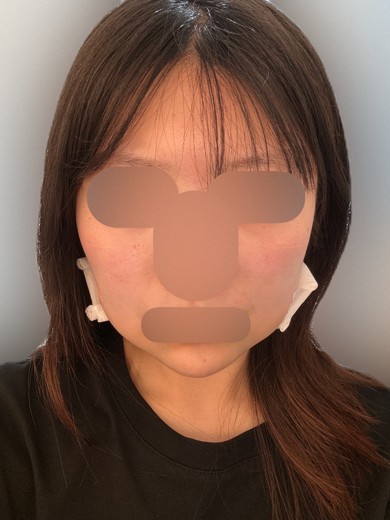 after photo: 脂肪吸引(頬)