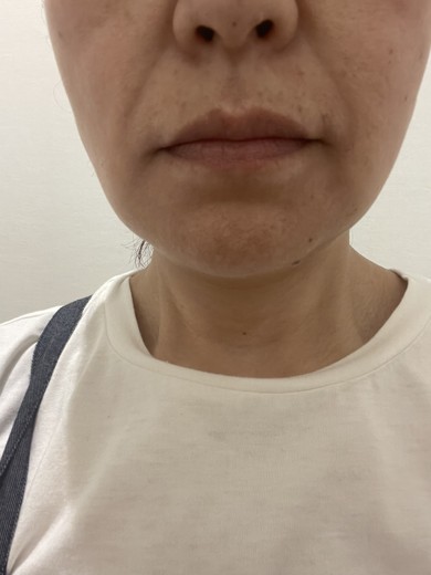 before photo: 脂肪吸引(顔)