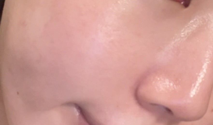 after photo: IPL(光/フォト治療), エレクトロポレーション, ルメッカ