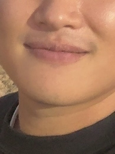 after photo: 턱제모