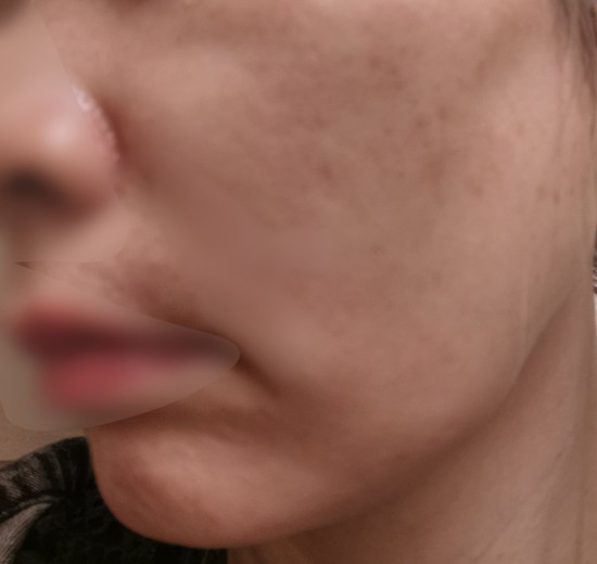 before photo: IPL(光/フォト治療)