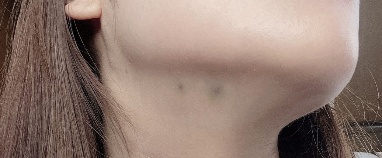 after photo: 脂肪溶解注射(顔)
