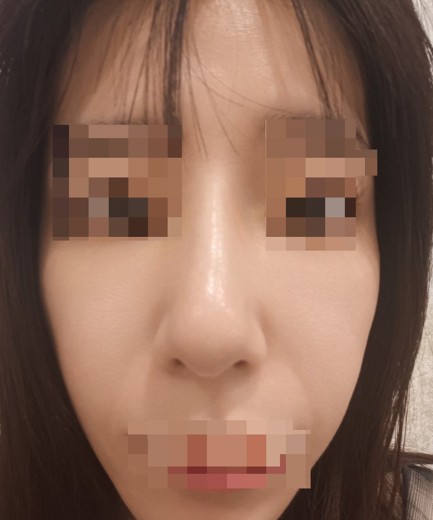 before photo: IPL(光/フォト治療), ピーリング, エレクトロポレーション