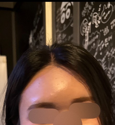 after photo: 이마필러