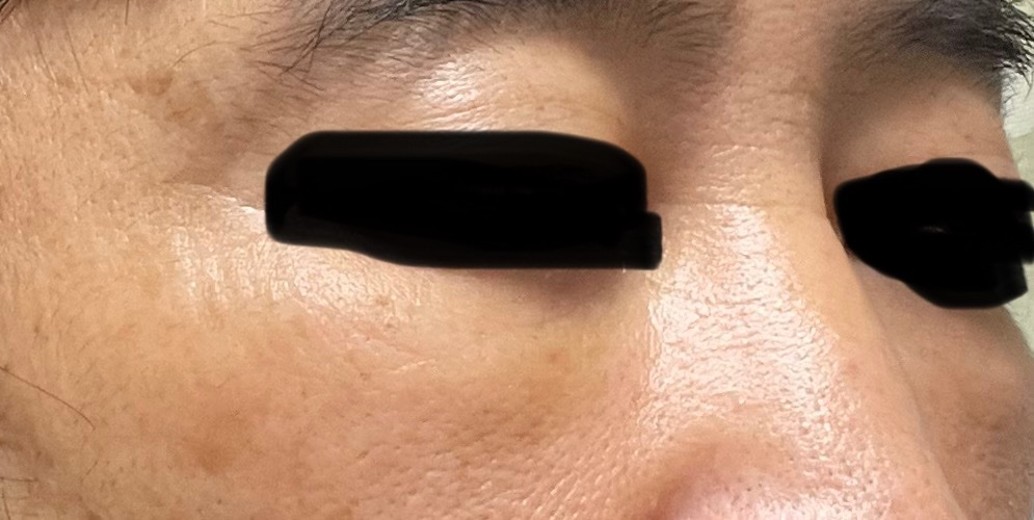 after photo: サーモン注射