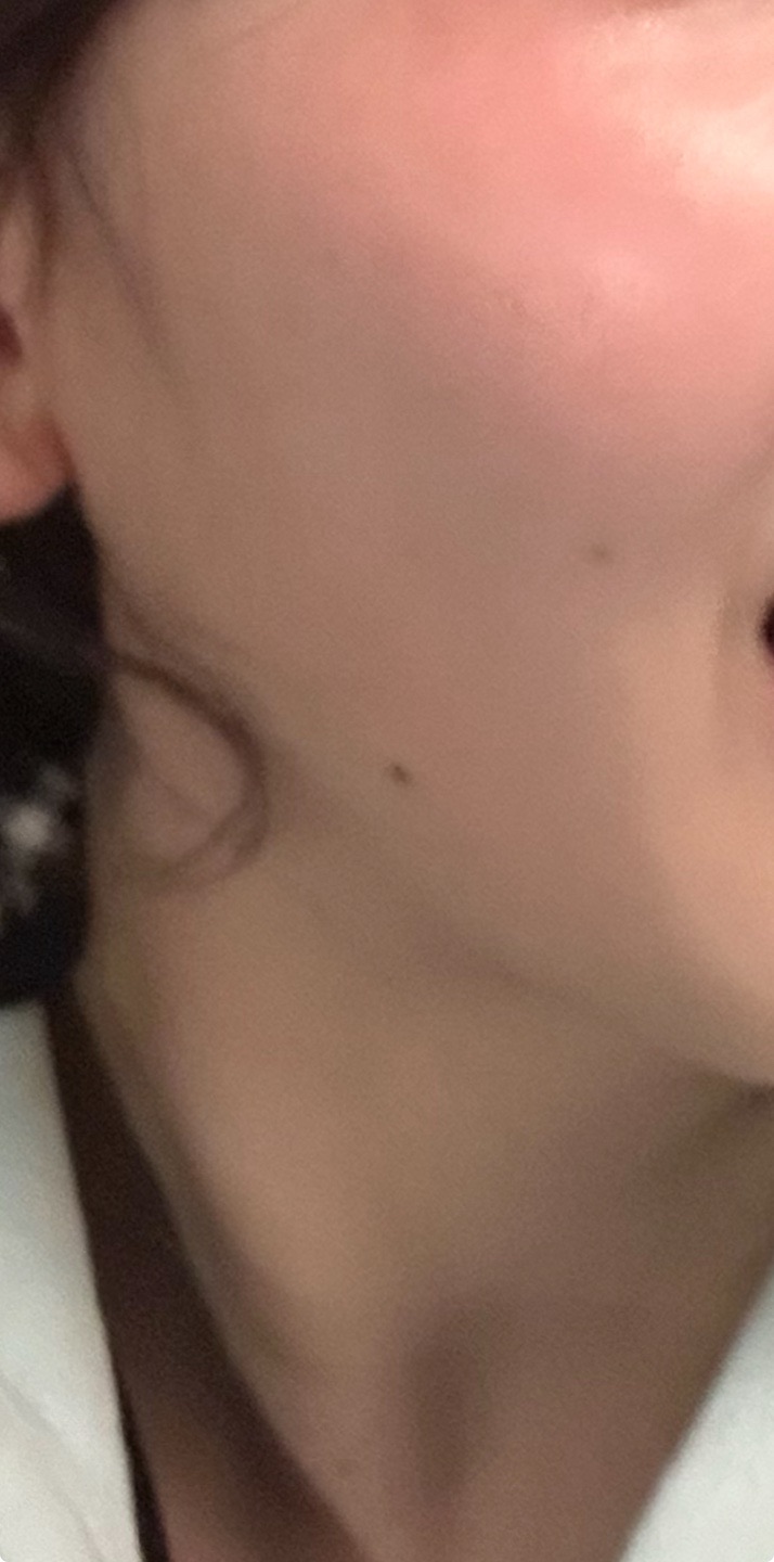 全顔シミ取り放題＋美顔レーザートーニング【12月29日迄にご予約頂いた