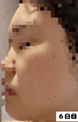 after photo: ダーマペン