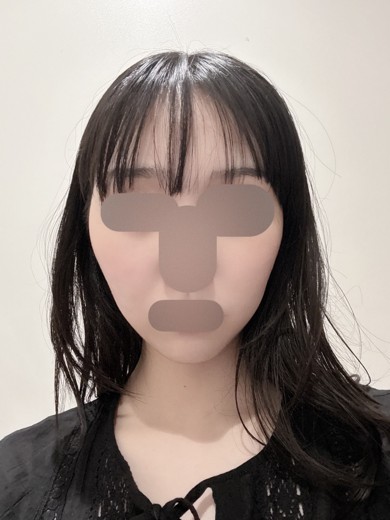 before photo: 脂肪溶解注射(顔)