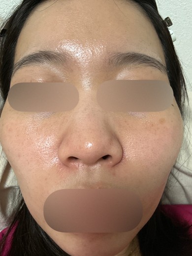 before photo: ハイドラフェイシャル