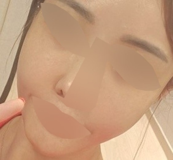 before photo: 스킨보톡스