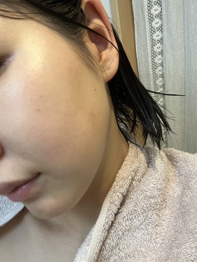 after photo: ピーリング, 診断・検査