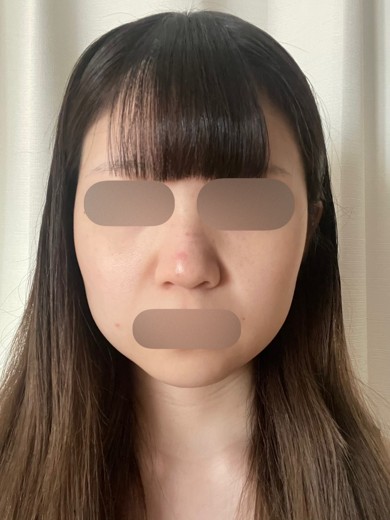 before photo: ダーマペン, エクソソーム