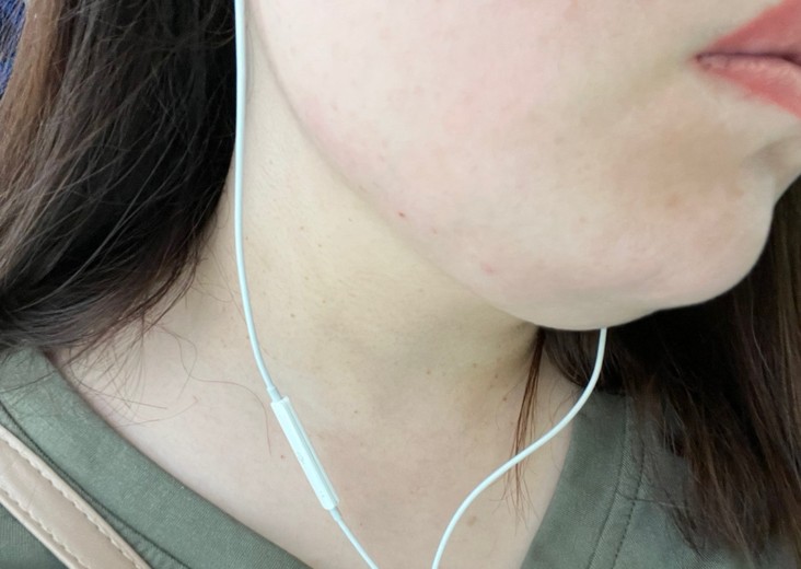 after photo: 脂肪溶解注射(顔)