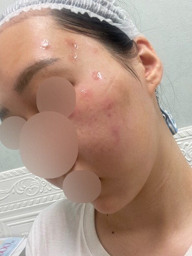 after photo: ピコスポット