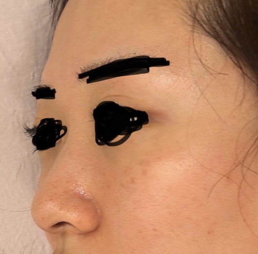 after photo: フラクショナルレーザー, エレクトロポレーション