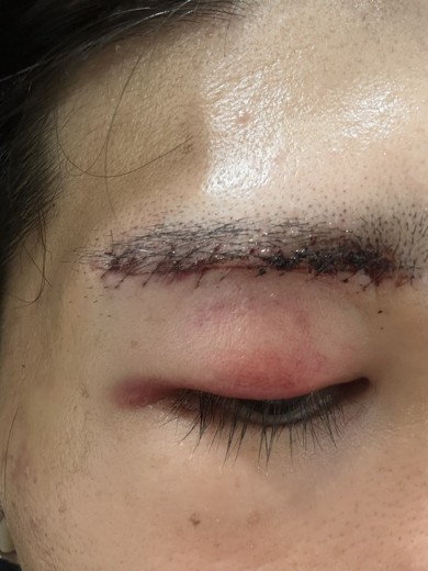 after photo: 眼瞼下垂(目つき矯正)