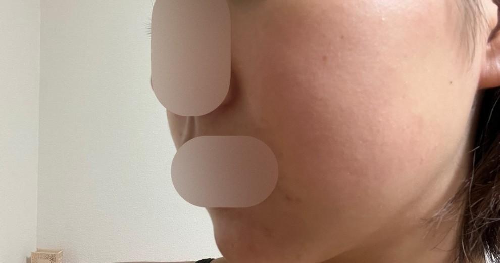 after photo: ピーリング, 診断・検査