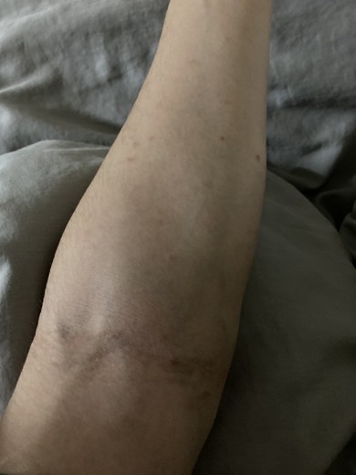 after photo: エクソソーム, 美容注射・点滴