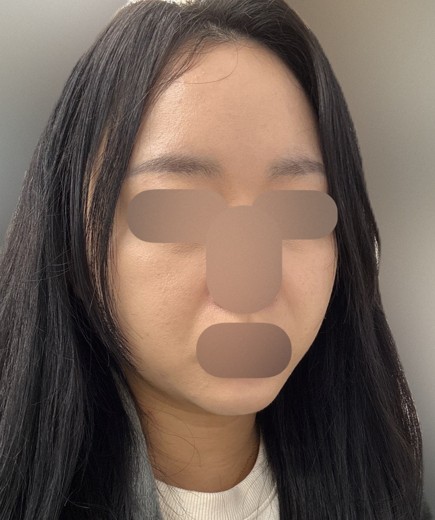 after photo: 온다리프팅