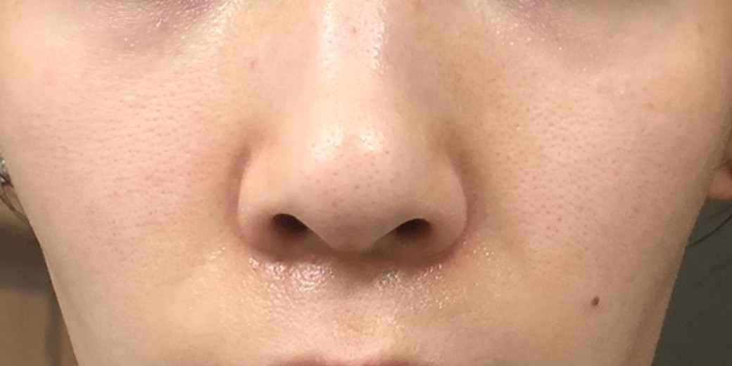 after photo: エレクトロポレーション