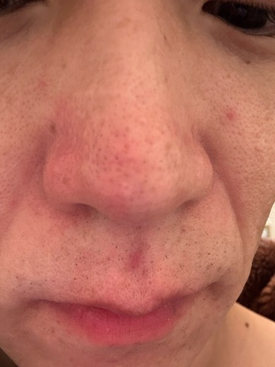 before photo: 糸リフト, 診断・検査