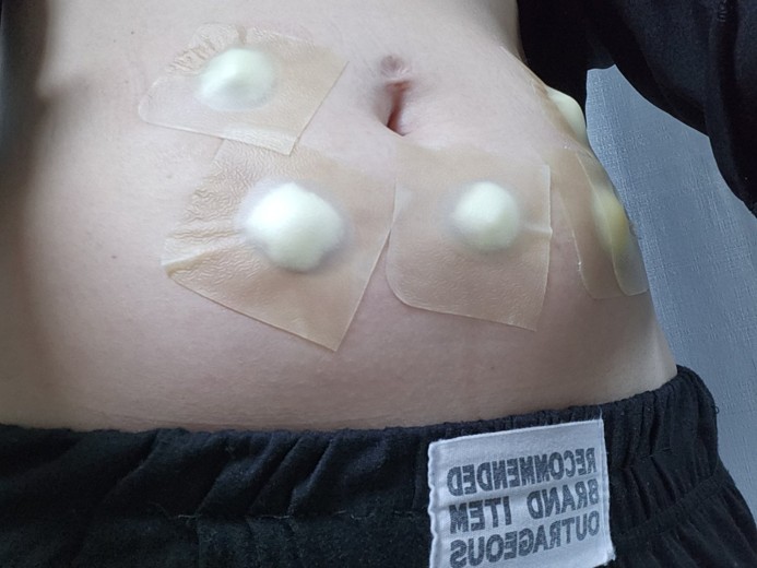 before photo: 복부지방분해주사, 팔지방분해주사