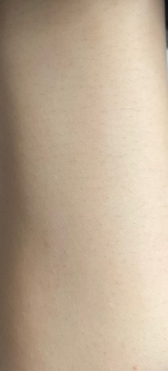 after photo: 팔제모, 종아리제모