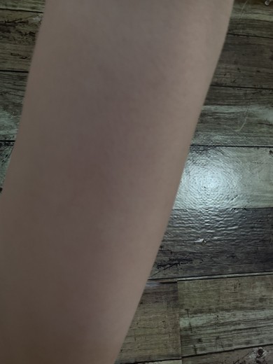 before photo: 脂肪冷却(腕)