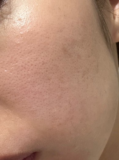 after photo: IPL(光/フォト治療), ルメッカ