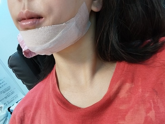 after photo: 턱끝보형물제거